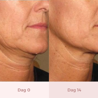 VitalLift™ LED Full Treatment